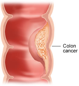 Cancerul de colon - semnele si simptomele lui